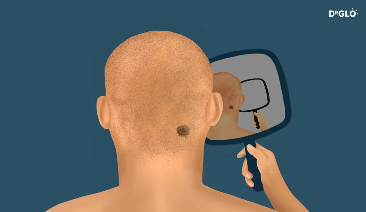Melanoma Skin Cancer Risk Assessment - Dr. Glo - Protect yourself by protecting your skin.