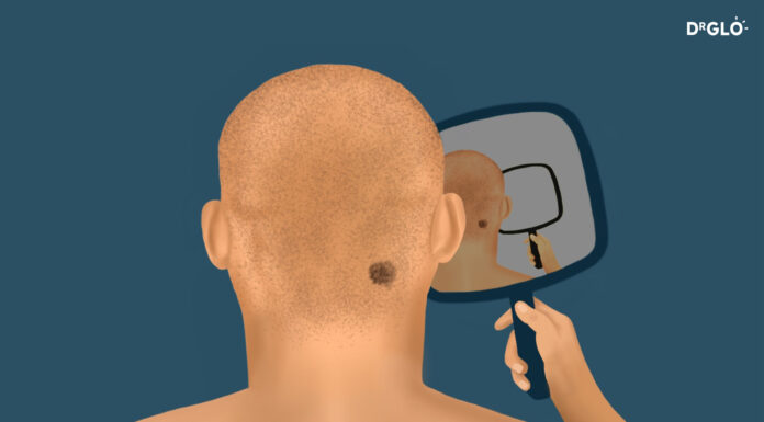 Melanoma Skin Cancer Risk Assessment A3-4 Melanoma skin cancer risk assessment