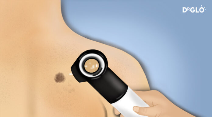 How Do You Get Tested for Melanoma