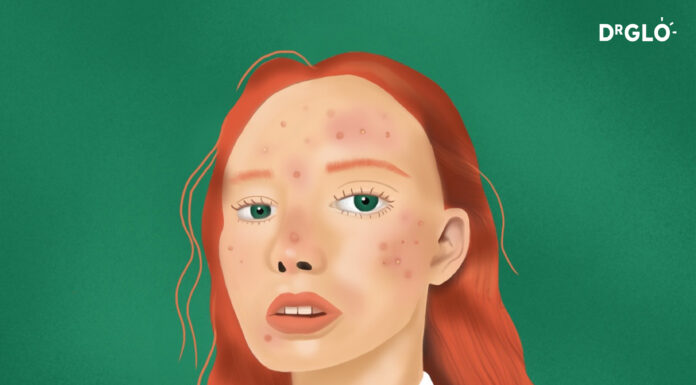 Acne 101 acne article hero image