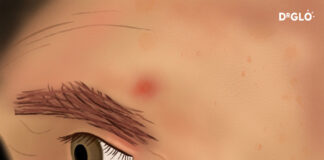 How to Spot a BCC (Basal Cell Carcinoma) bbc_(A_reddish_patch_or_irritated_area)