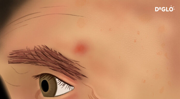 How to Spot a BCC (Basal Cell Carcinoma) bbc_(A_reddish_patch_or_irritated_area)