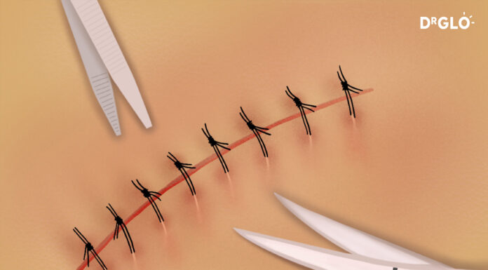 Scar Management – Wound Care After Suture Removal